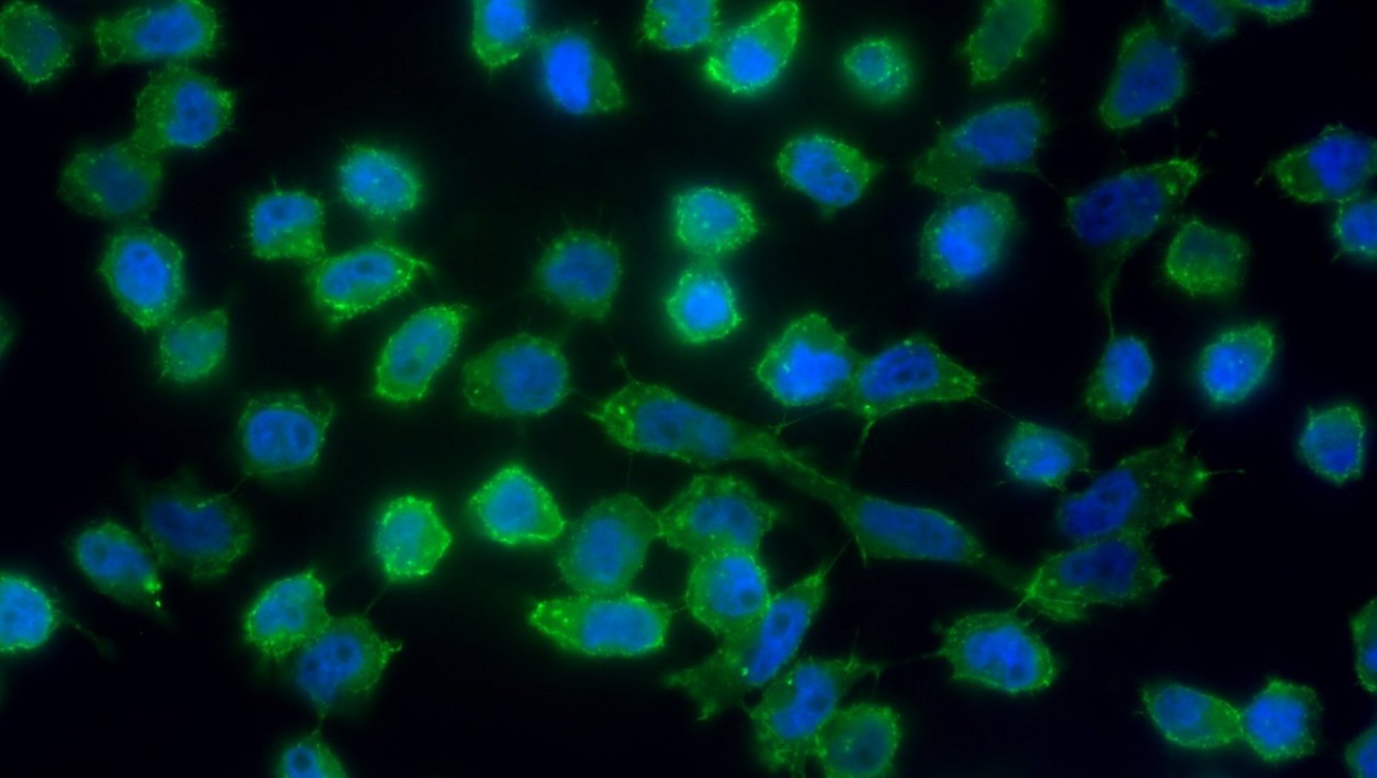 Pancreatic tumour cells, César Rodriguez Santana